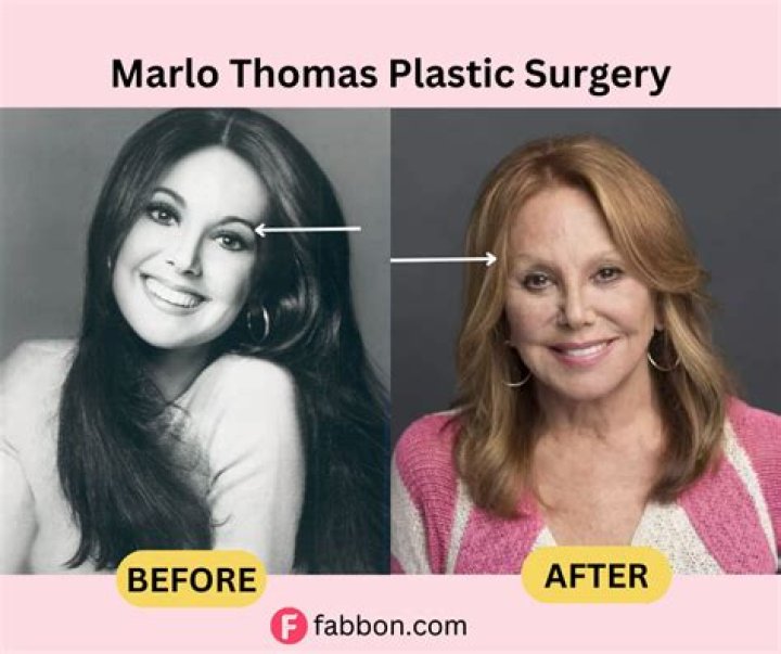 Did Marlo Thomas Reshape Her Nose?