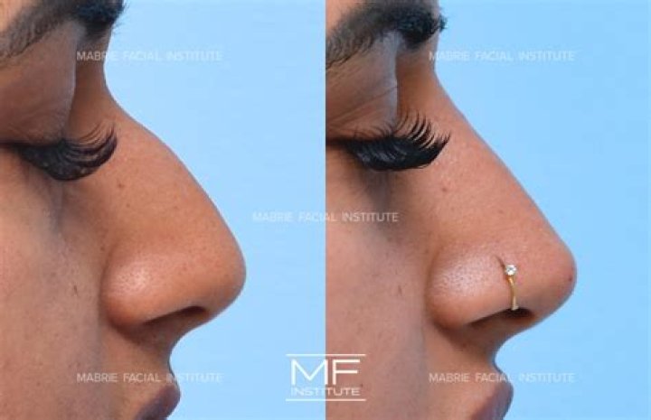 Matthew Perry's Nose Job: A Transformation Examined