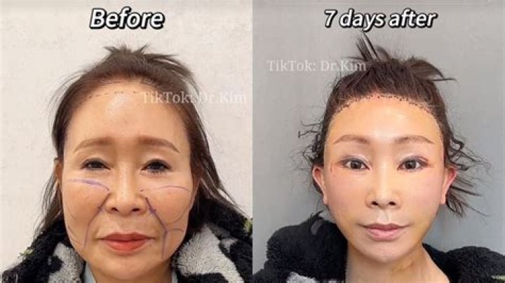 Moon Ga Young's Plastic Surgery: Before And After Analysis
